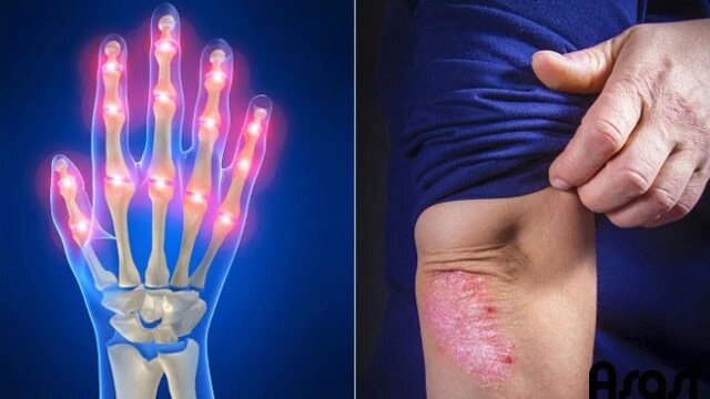 cach-theo-doi-benh-viem-khop-vay-nen-ma-ban-can-biet 1.jpg