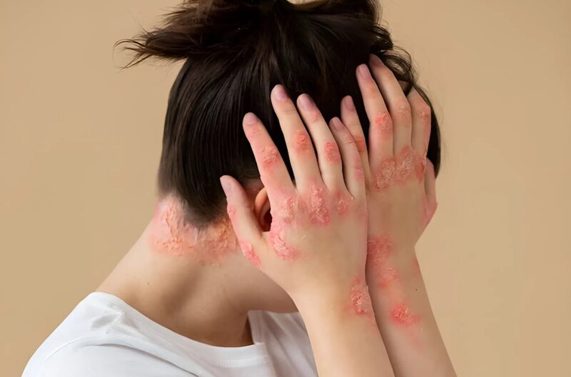 cach-theo-doi-benh-viem-khop-vay-nen-ma-ban-can-biet 2.jpg