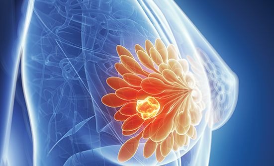 Cách tiếp cận ung thư vú giai đoạn chưa di căn 1
