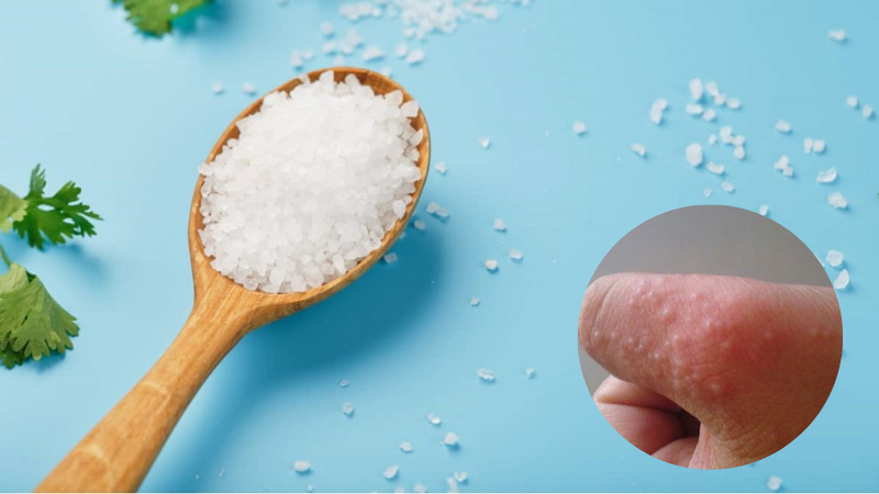 Cách trị mụn nước ở tay bằng muối nhanh chóng, an toàn, hiệu quả 7