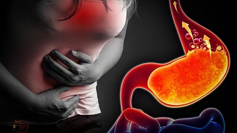 Trào ngược dạ dày lưỡi trắng1