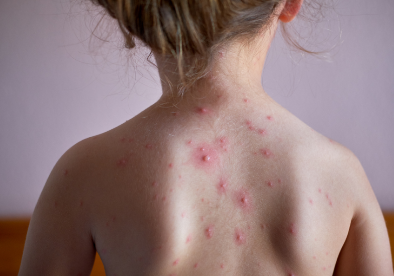 Cách vệ sinh khi bị thủy đậu như thế nào là đúng? 1