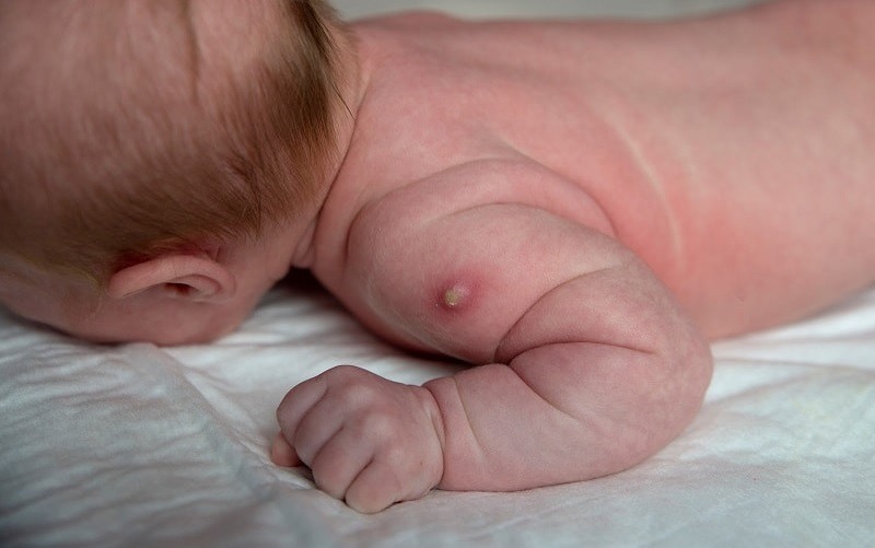 Cách vệ sinh vết tiêm phòng lao như thế nào? 2