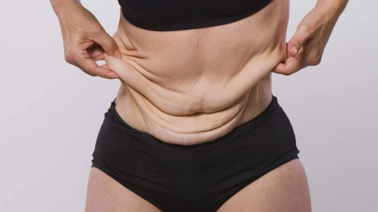 Cách xử lý da nhăn khi giảm cân như thế nào? 1