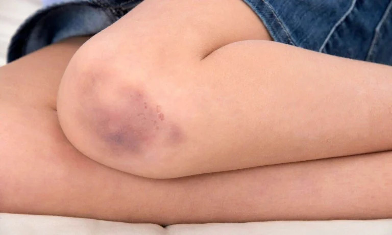 cach-xu-ly-vet-thuong-phan-mem-dung-cach-va-lam-sao-de-vet-thuong-phan-mem-mau-lanh 1.jpg