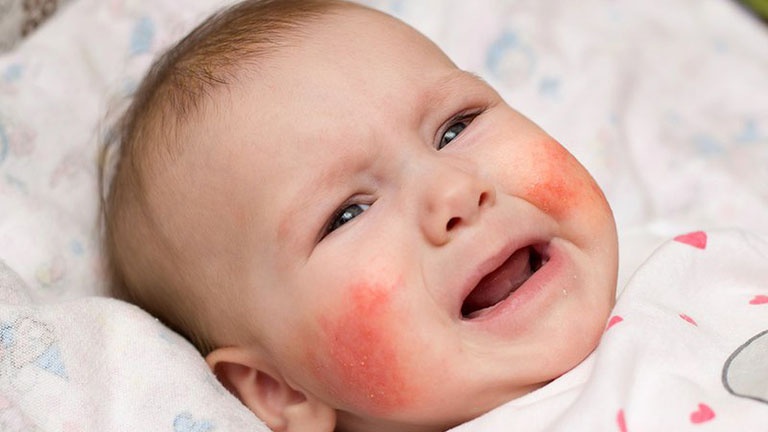 Cách xử trí khi sốc phản vệ ở trẻ em ba mẹ cần biết 1