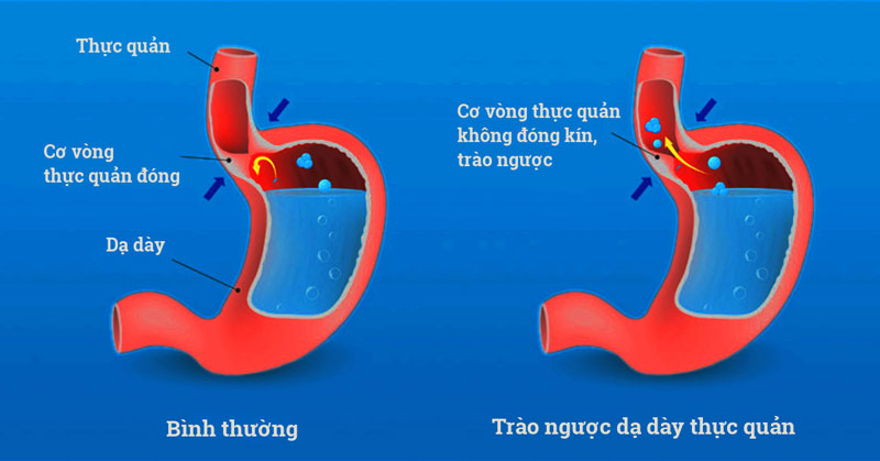 Cải thiện triệu chứng trào ngược dạ dày và viêm loét tá tràng1