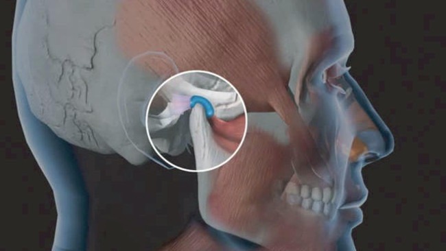 Cảm giác bị đau cơ hàm nhai là bệnh gì? 1