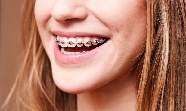 Cắm vít niềng răng bao lâu thì tháo? Niềng răng cần lưu ý những gì? 1