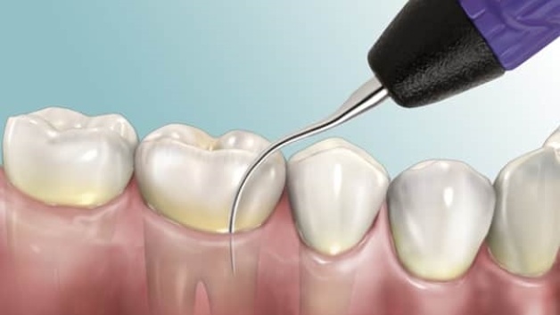 Cao răng có mấy cấp độ? Cách xử lý cao răng hiệu quả 1