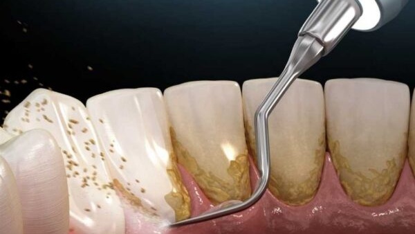 Cao răng có mấy cấp độ? Cách xử lý cao răng hiệu quả 2