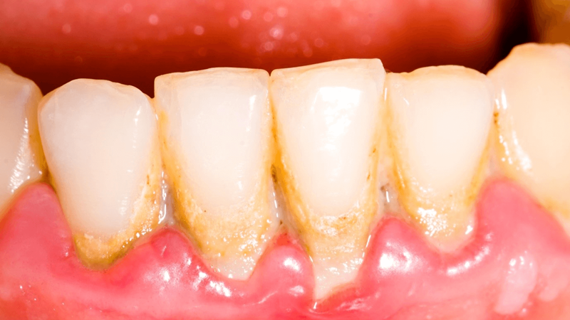 Cao răng có mấy cấp độ? Cách xử lý cao răng hiệu quả 3