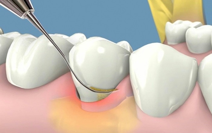 cao-voi-rang-va-tay-trang-rang-cung-luc-co-duoc-khong 1.jpg