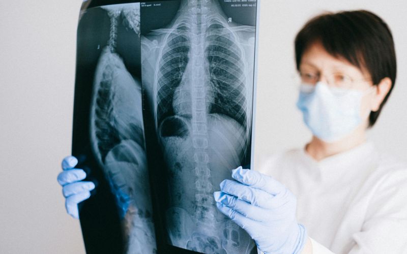 Chụp X-quang phổi là phương pháp cận lâm sàng được chỉ định ở hầu hết bệnh nhân giãn phế quản