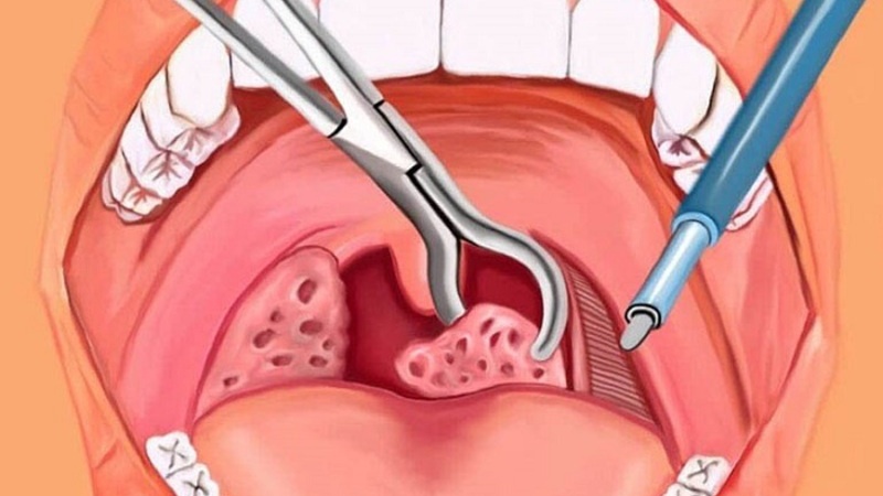 Cắt amidan cho trẻ có cần gây mê không? 1