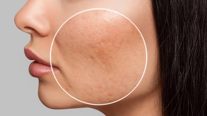Cắt đáy sẹo rỗ là phương pháp điều trị được đánh giá cao
