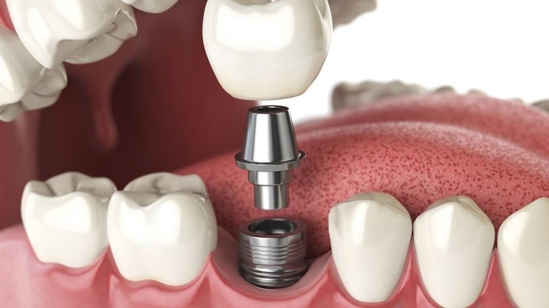 Cầu răng sứ và implant: Nên chọn phương pháp nào? So sánh chi tiết 3
