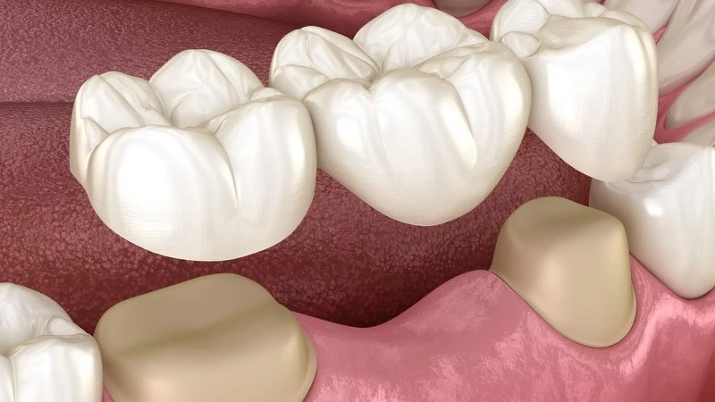 Cầu răng sứ và implant: Nên chọn phương pháp nào? So sánh chi tiết 4