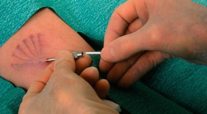 Cấy que tránh thai bị mất kinh có đáng lo ngại không? 4