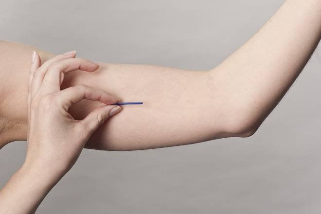 Cấy que tránh thai là gì? Những tác dụng phụ của cấy que tránh thai 1