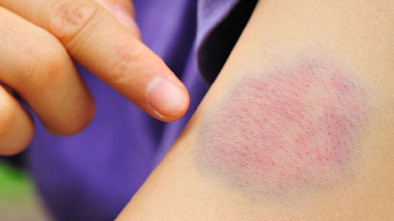 Châm cứu sai huyệt có nguy hiểm không? Những biến chứng thường gặp 4