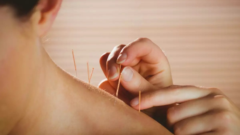 Châm cứu sai huyệt có nguy hiểm không? Những biến chứng thường gặp 1