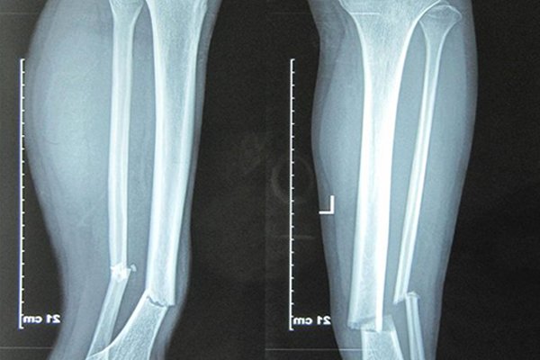 cham-lien-xuong-nguyen-nhan-va-dau-hieu-la-gi 3.png