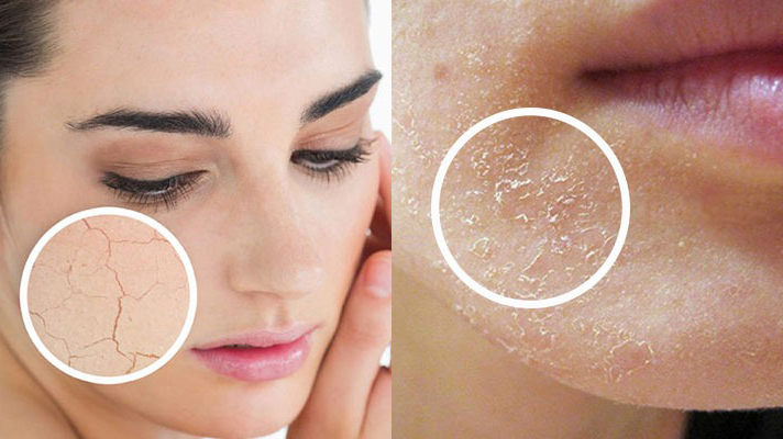 Chăm sóc da khô mùa đông​ hiệu quả: Bí quyết để có làn da ẩm mịn, không bong tróc 4