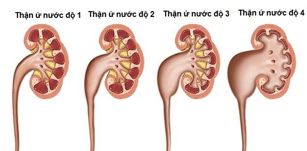 Chẩn đoán phân độ thận ứ nước trên siêu âm3