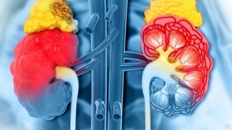 Chẩn đoán u thận bằng sinh thiết thận dưới cắt lớp vi tính 1