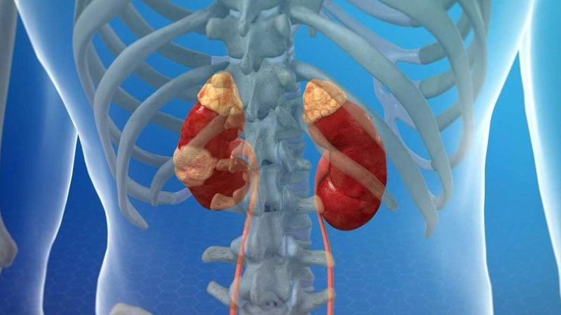 Chẩn đoán u thận bằng sinh thiết thận dưới cắt lớp vi tính 2