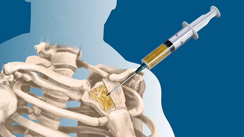 Chẩn đoán u xương ác tính nhờ sinh thiết xương dưới cắt lớp vi tính 2