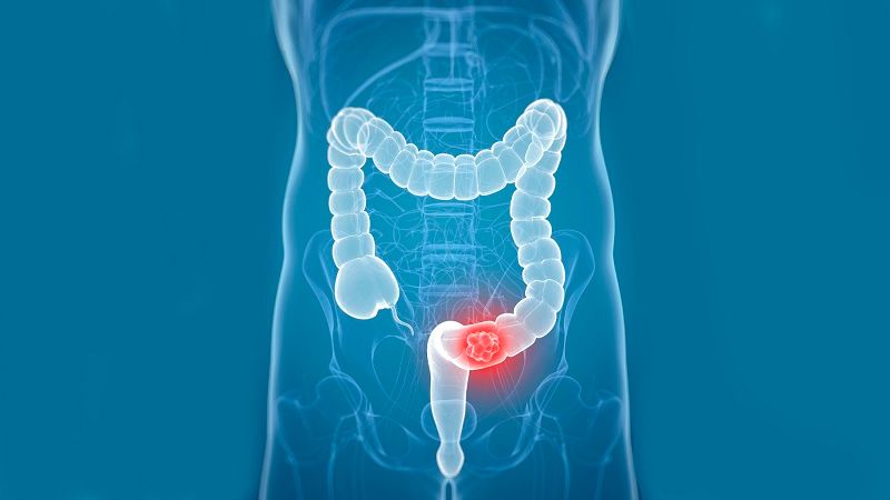 Chẩn đoán ung thư đại trực tràng bằng sinh thiết lỏng Guardant Reveal 1