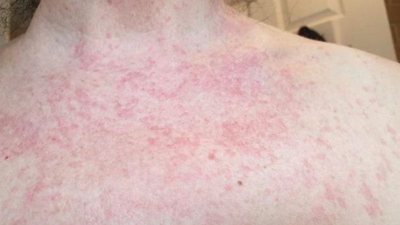 Chẩn đoán ung thư vú nhờ sinh thiết vú có hỗ trợ hút chân không 3