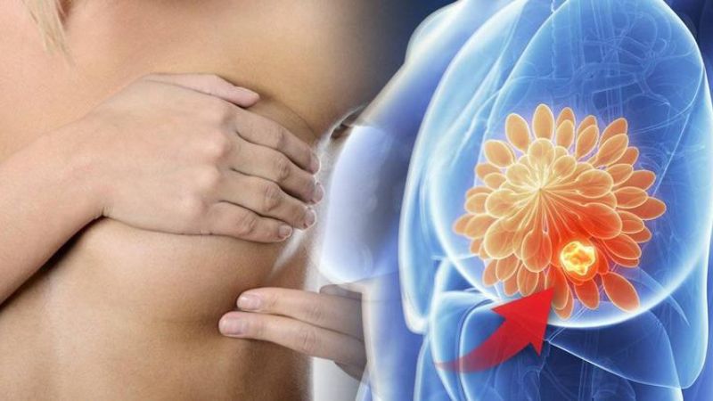 Chẩn đoán ung thư vú nhờ sinh thiết vú có hỗ trợ hút chân không 4