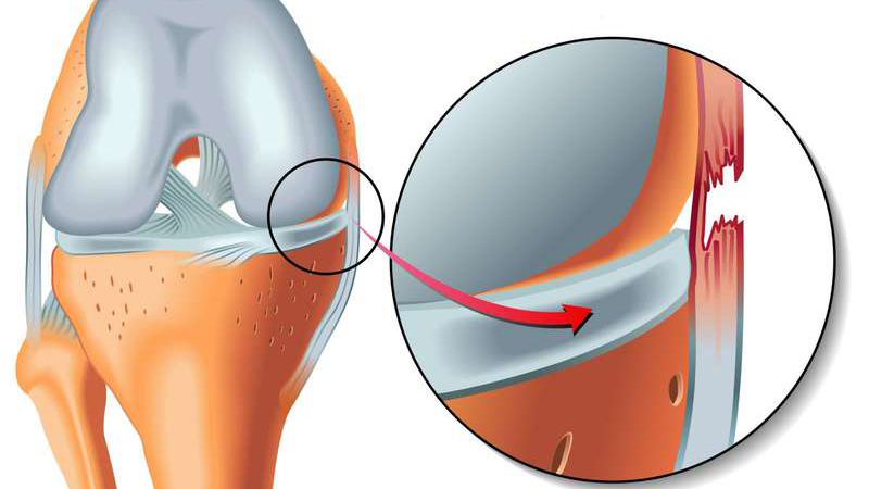 Chấn thương dây chằng chéo sau: Nguyên nhân, triệu chứng và cách điều trị 1