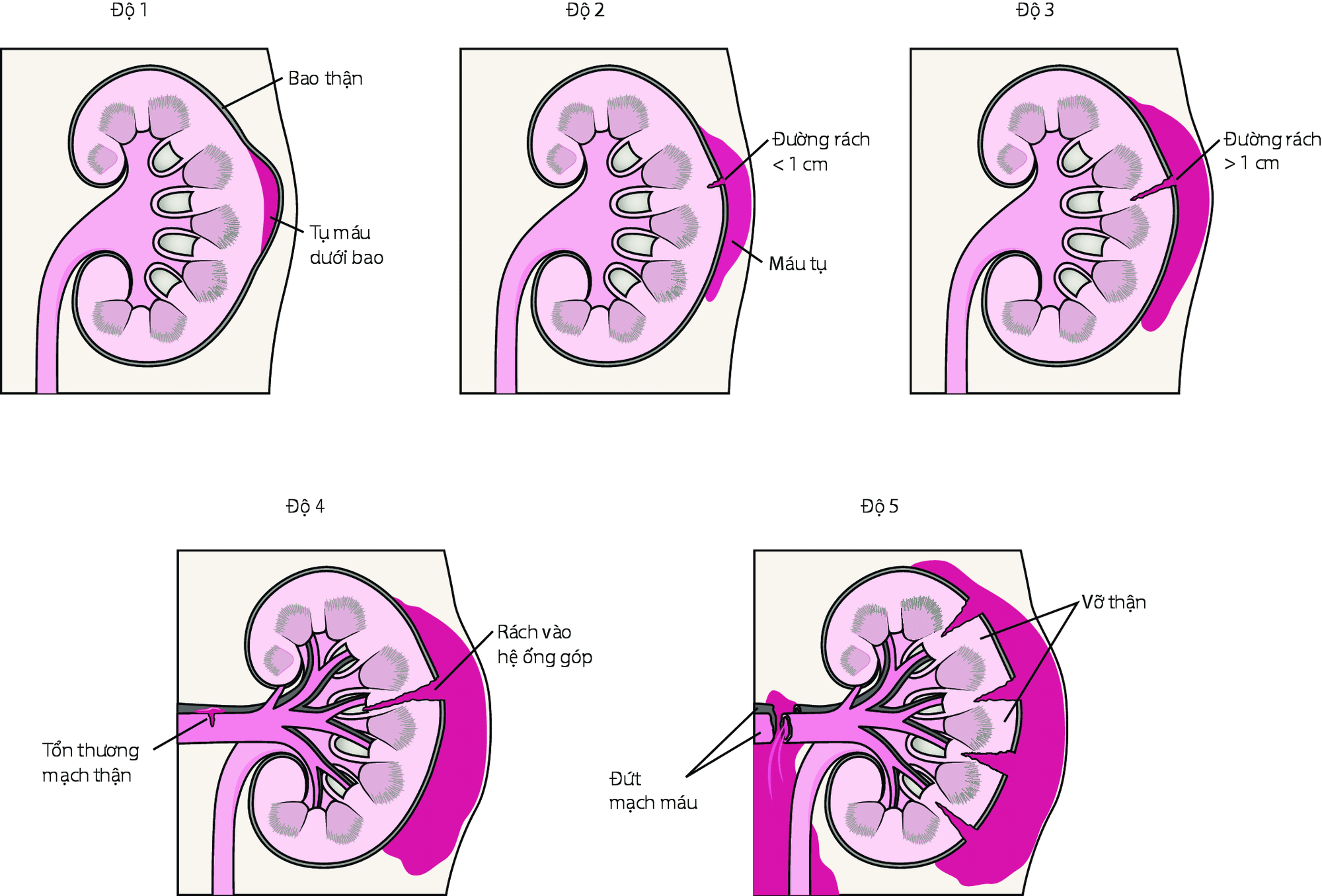 Chấn thương thận kín và những triệu chứng của nó 1