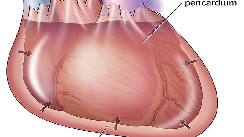 Chèn ép tim cấp là gì? Chẩn đoán và điều trị như thế nào? 1