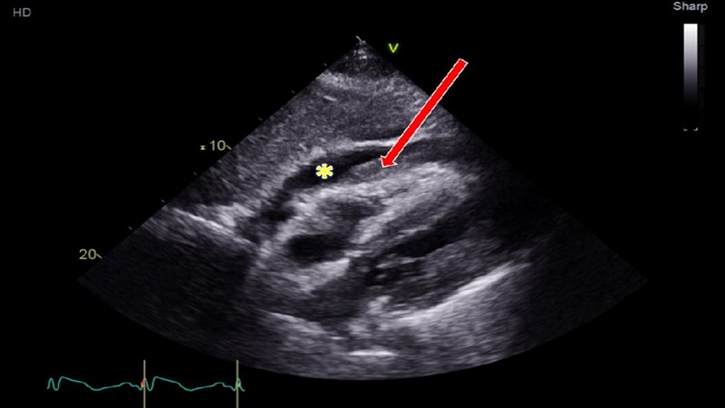 Chèn ép tim cấp là gì? Chẩn đoán và điều trị như thế nào? 4