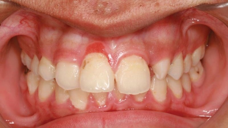 Chép miệng, chảy máu chân răng phải làm sao? 3