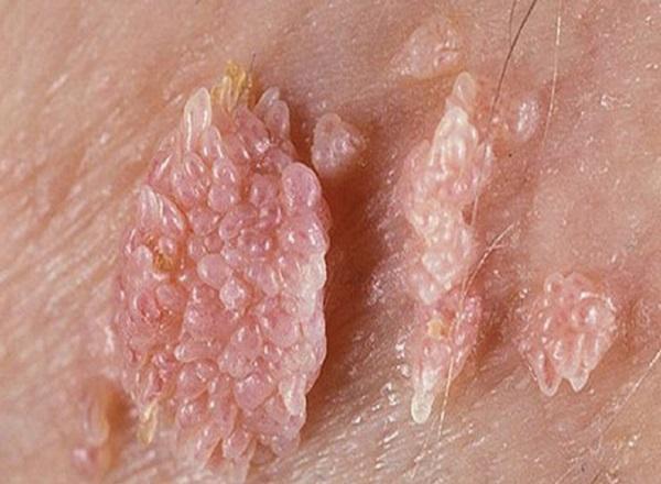 chi-phi-chua-sui-mao-ga-het-bao-nhieu-tien 4