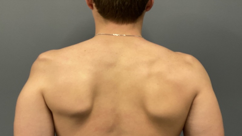 Chi phí mổ teo cơ delta là bao nhiêu? Cập nhật chi tiết nhất 4