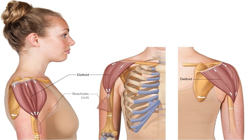 Chi phí mổ teo cơ delta là bao nhiêu? Cập nhật chi tiết nhất 5