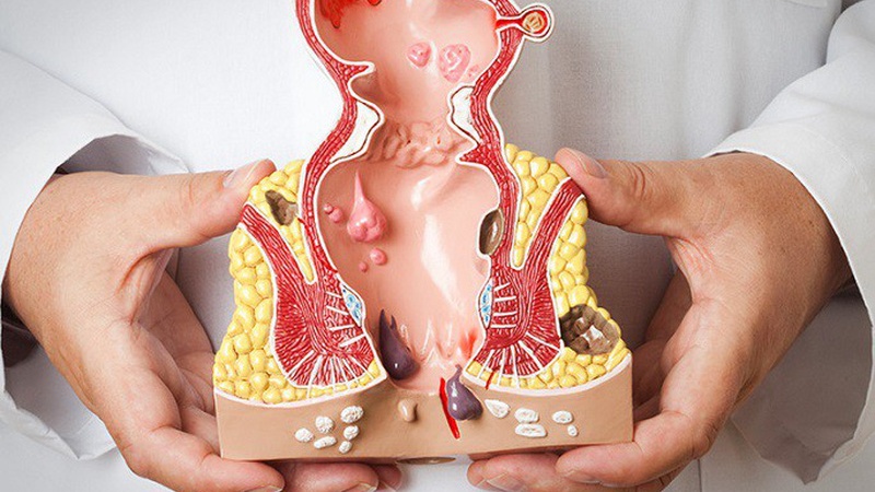 Giải đáp chi phí mổ trĩ có bảo hiểm y tế bao nhiêu?