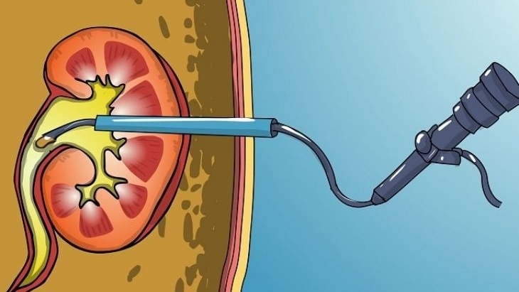 Chi phí tán sỏi thận qua da là bao nhiêu?