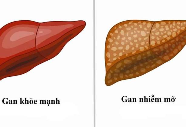 Chỉ số de ritis là gì? Ý nghĩa lâm sàng của chỉ số de ritis 4