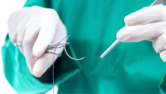 Chỉ tự tiêu bị rơi ra có sao không? 1