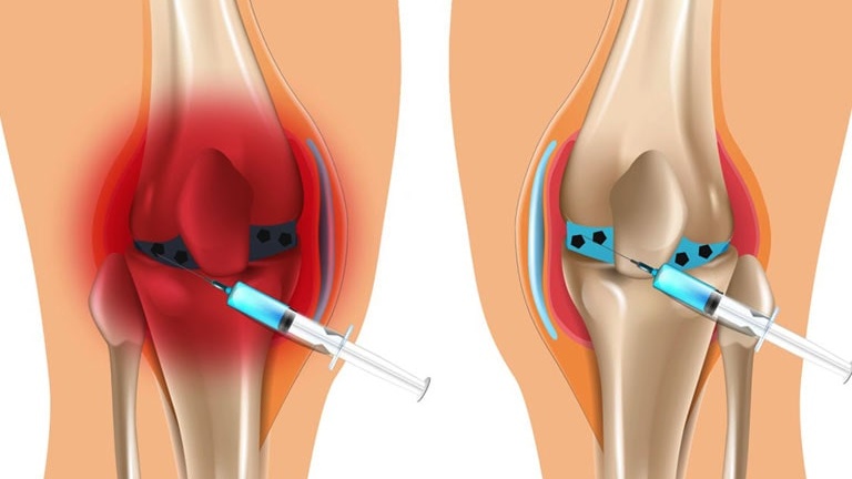 Phương pháp chọc dịch khớp gối có nguy hiểm hay không? 2