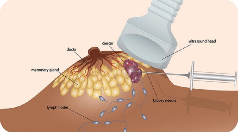 choc-hut-te-bao-tuyen-vu-chan-doan-va-tam-soat-ung-thu-vu 2.jpg