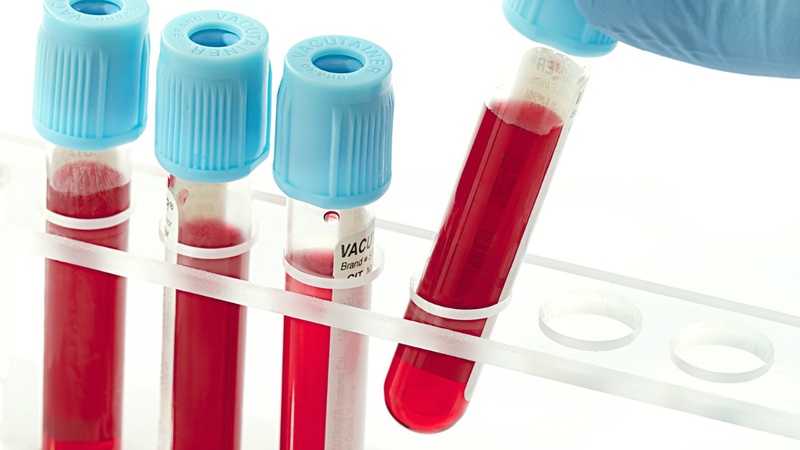 Cholesterol và triglycerid được chỉ định xét nghiệm khi nào? 3